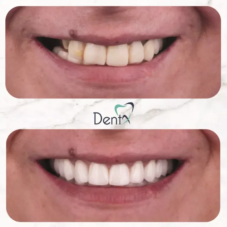 Dentx-Digital-Smile-Design-Hollywood-Smile-Before-Afters-28