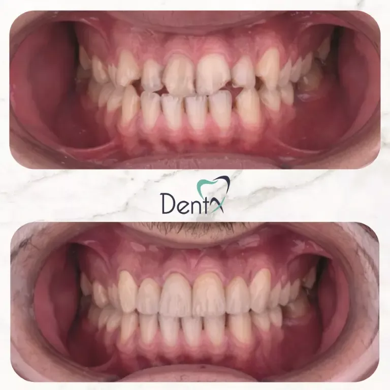 Dentx-Digital-Smile-Design-Hollywood-Smile-Before-Afters-30