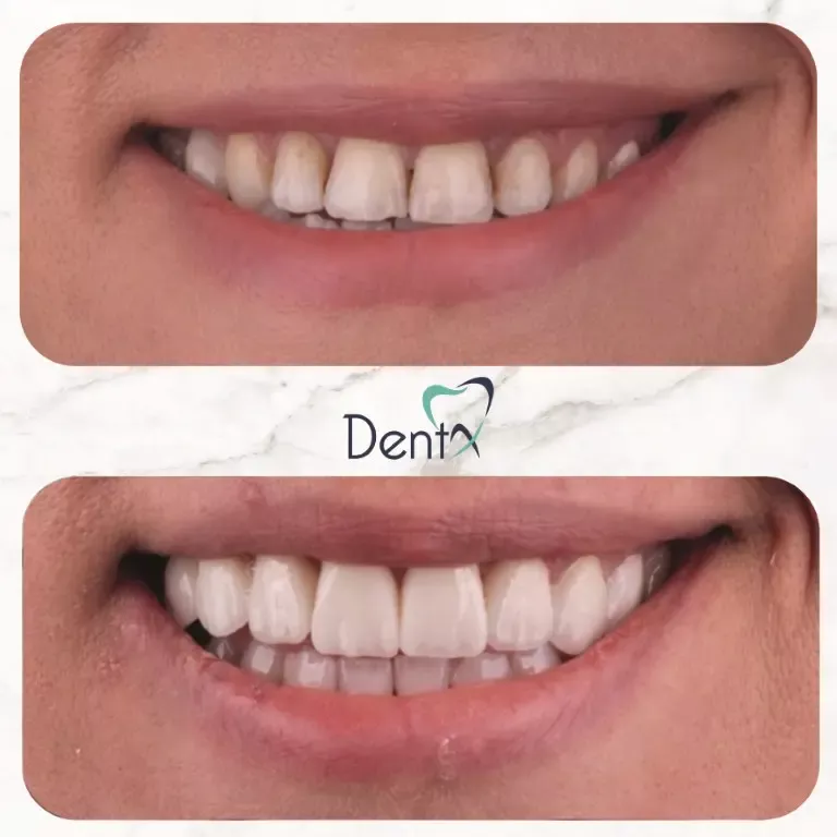 Dentx-Digital-Smile-Design-Hollywood-Smile-Before-Afters-31