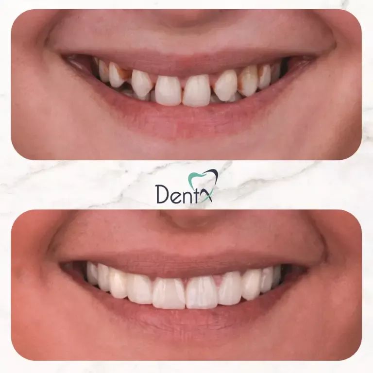 Dentx-Digital-Smile-Design-Hollywood-Smile-Before-Afters-36