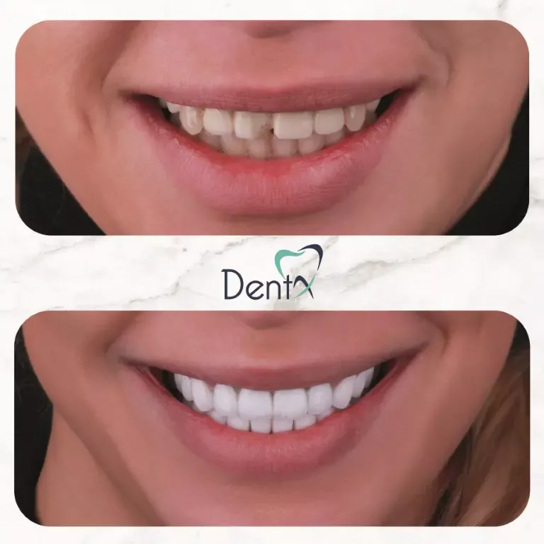 Dentx-Digital-Smile-Design-Hollywood-Smile-Before-Afters-37