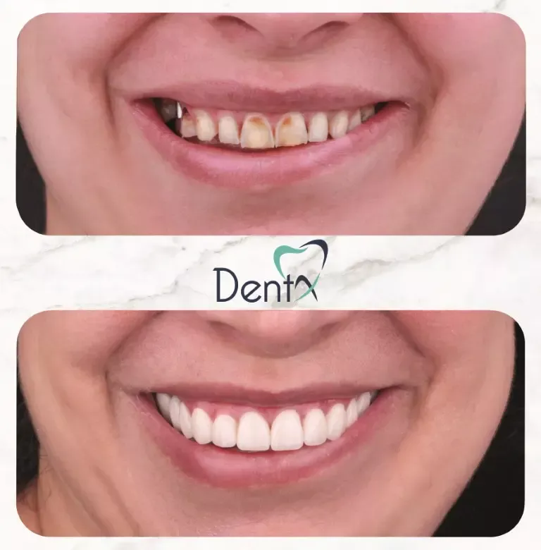 Dentx-Digital-Smile-Design-Hollywood-Smile-Before-Afters-40