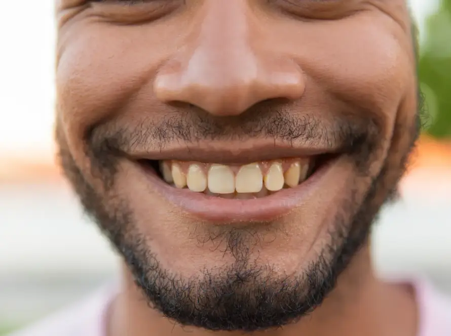 Calcium Deposits on Teeth Causes