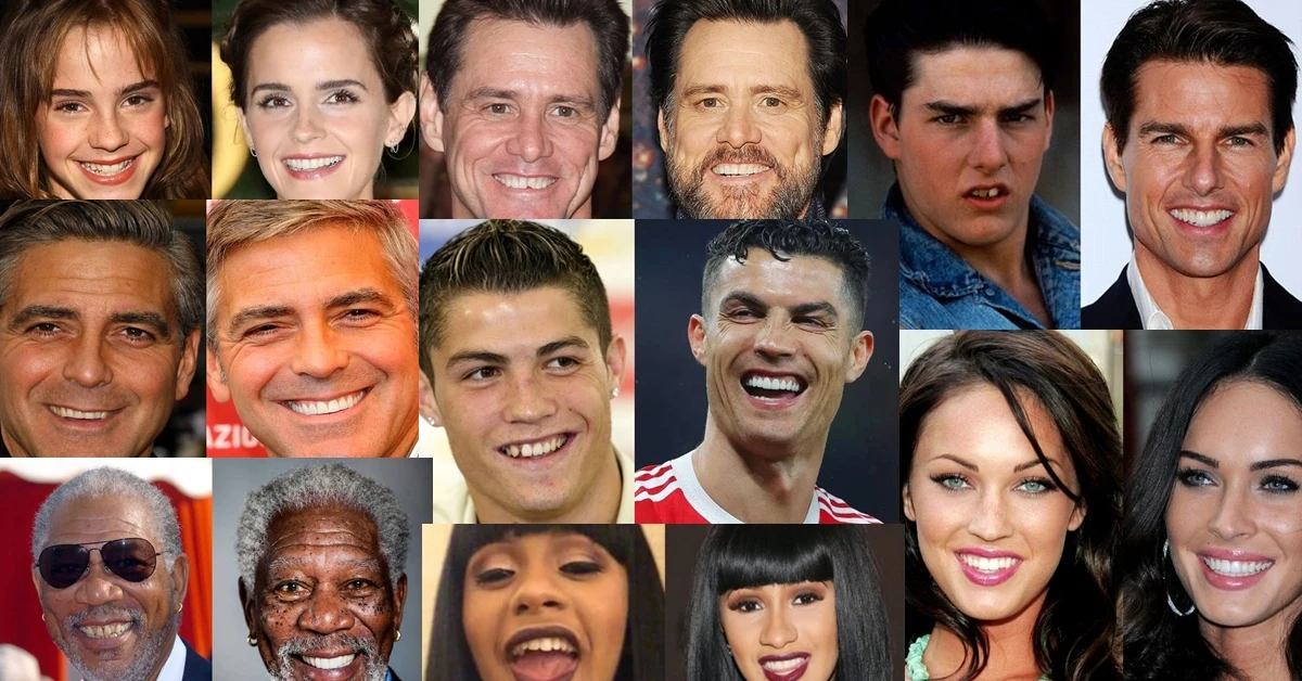 Celebrities with Dental Implants, Veneers, Bridges and Crown