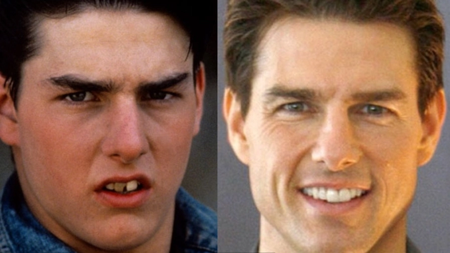 Tom Cruise dental implant