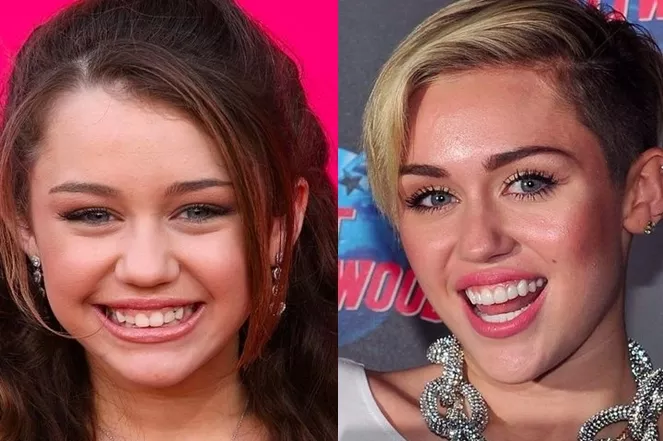 miley cyrus teeth before