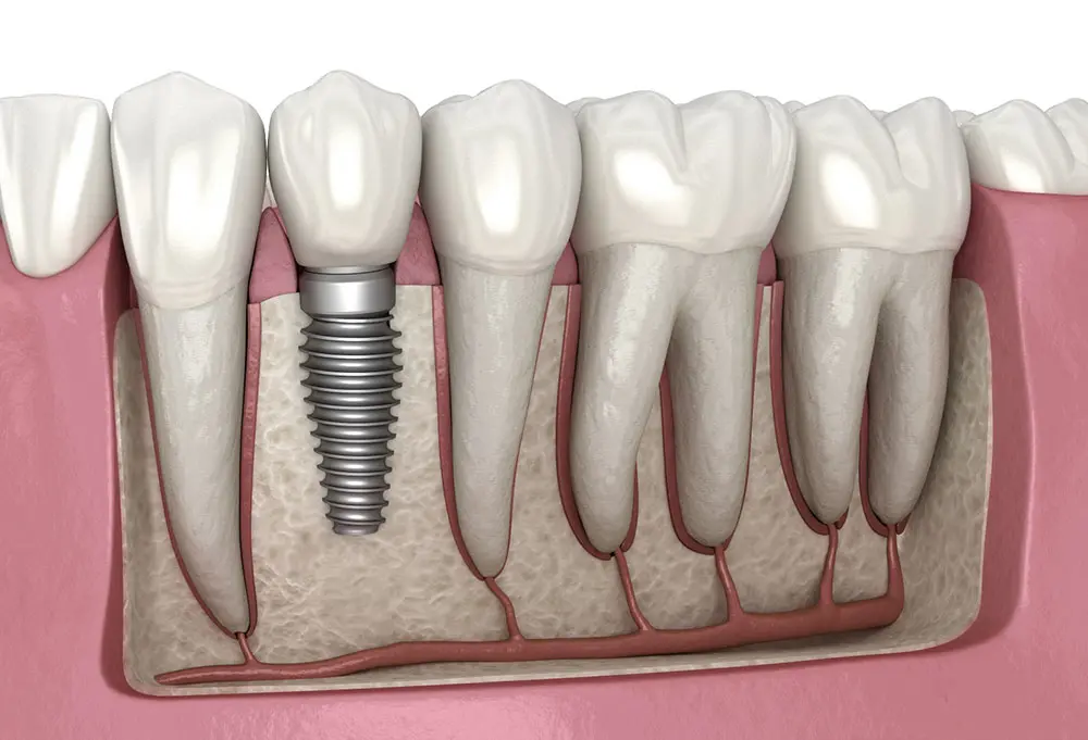 How Much Do Dental Implants Costs (2024) Dent X International